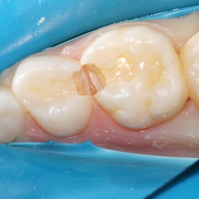 Kids Dental Fillings