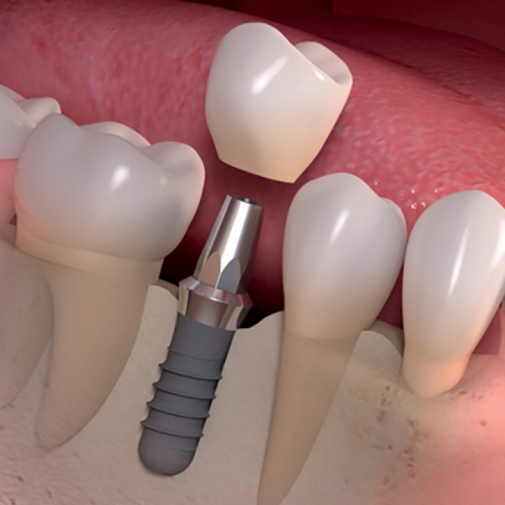 What Are Dental Implants