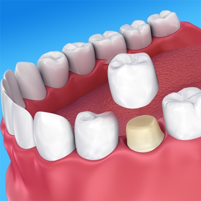 Dental Crowns