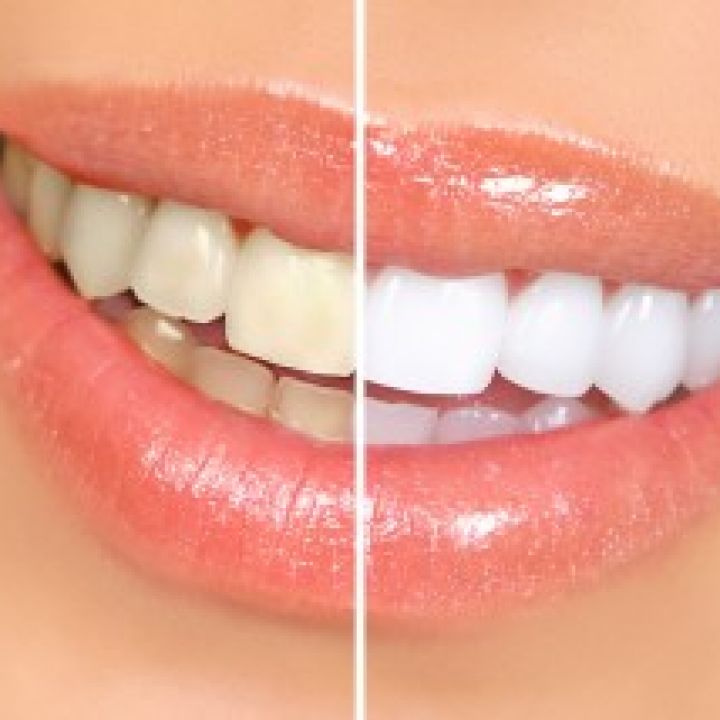 Teeth Whitening Cape Town