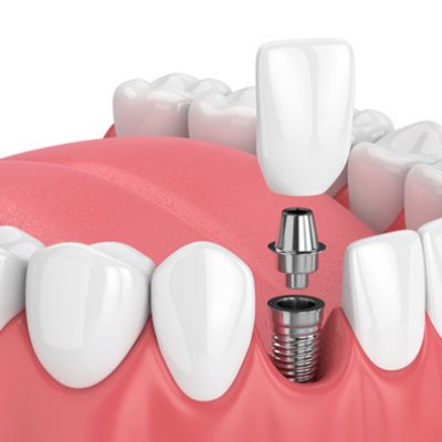 Restoring the Implant 