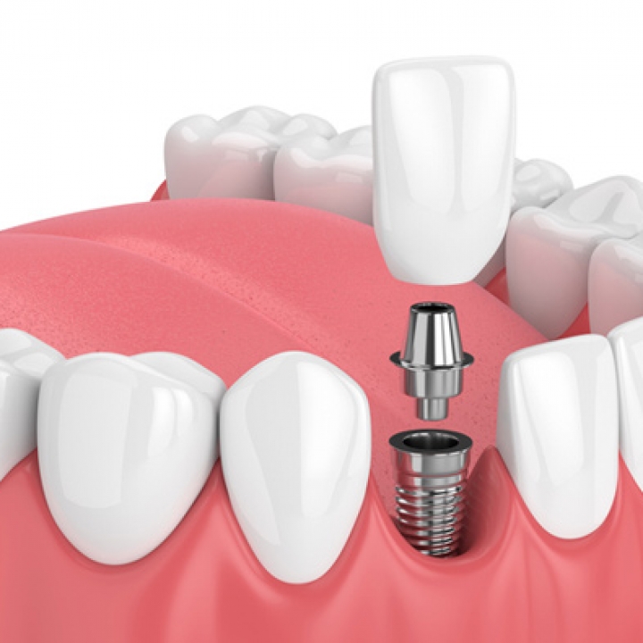 Restoring the Implant