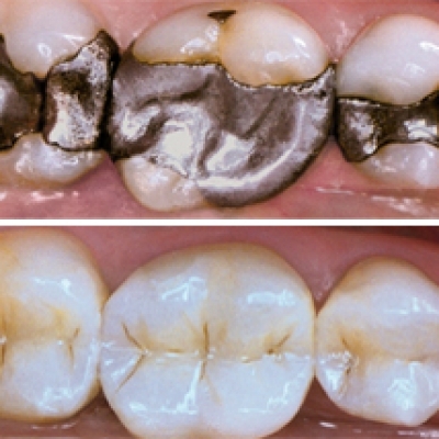 Composite Resin Fillings