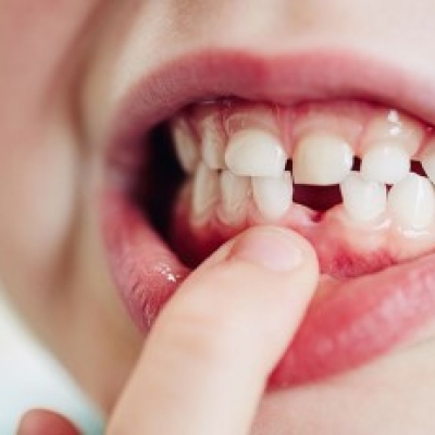 Kids Dental Extractions