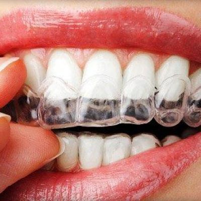 Custom Tray Teeth Whitening